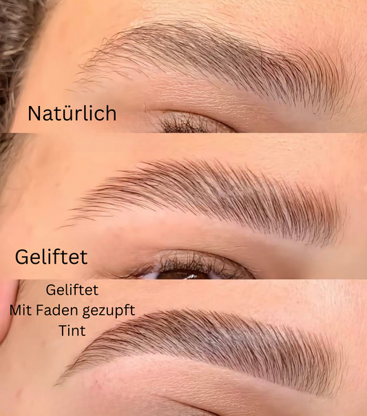 Brow Lift