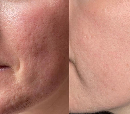 RF-Microneedling