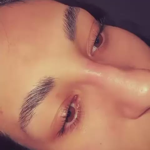 Brow Lift